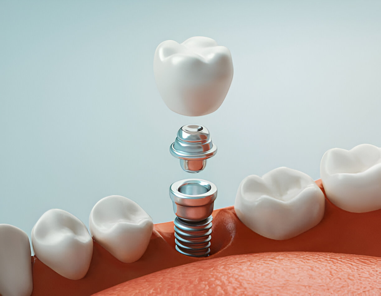 How to Choose the Best Type of Dental Implant for Your Needs_1