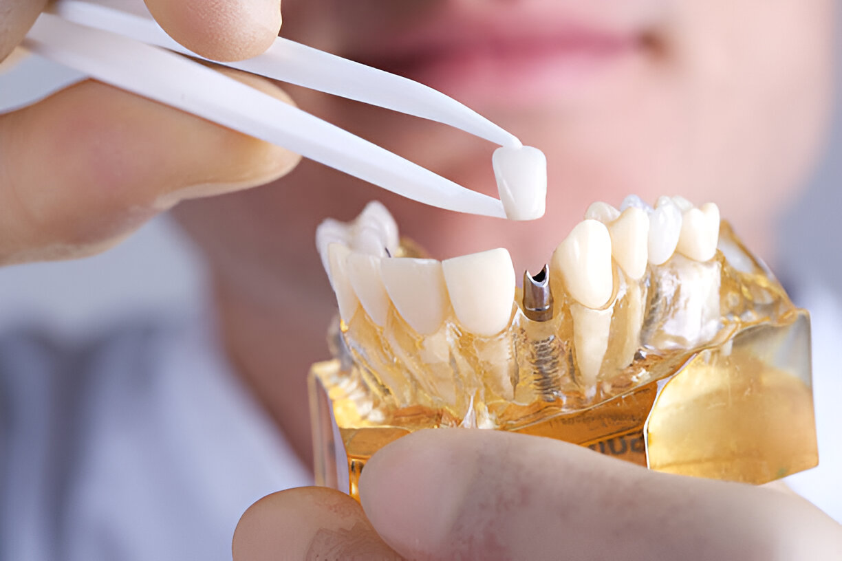 How to Choose the Best Type of Dental Implant for Your Needs_3