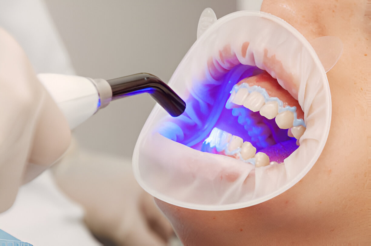 Expert Teeth Whitening Services at Seven Hills Dentistry: Your Trusted Dentist in Dallas, GA_2